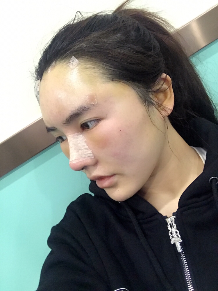 膨体隆鼻手术过程