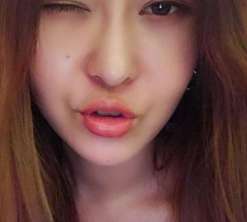 开始玻尿酸丰唇手术