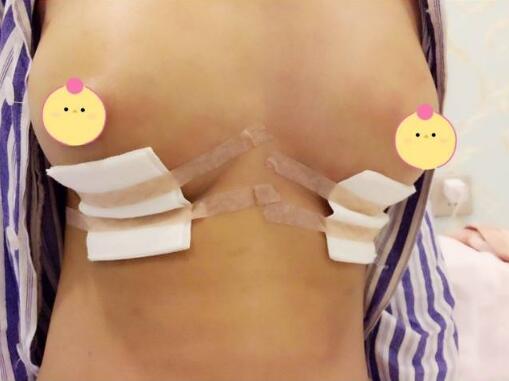 琴面假体隆胸手术刚结束的时候