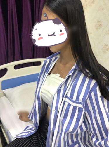 琴面假体隆胸前