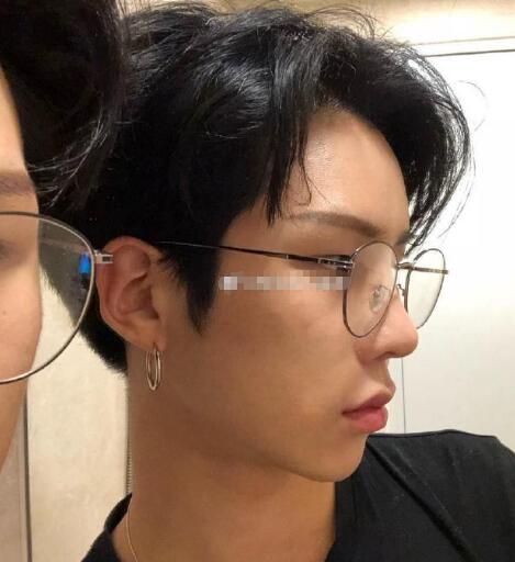 徐学东男士下颌角手术后的疗效