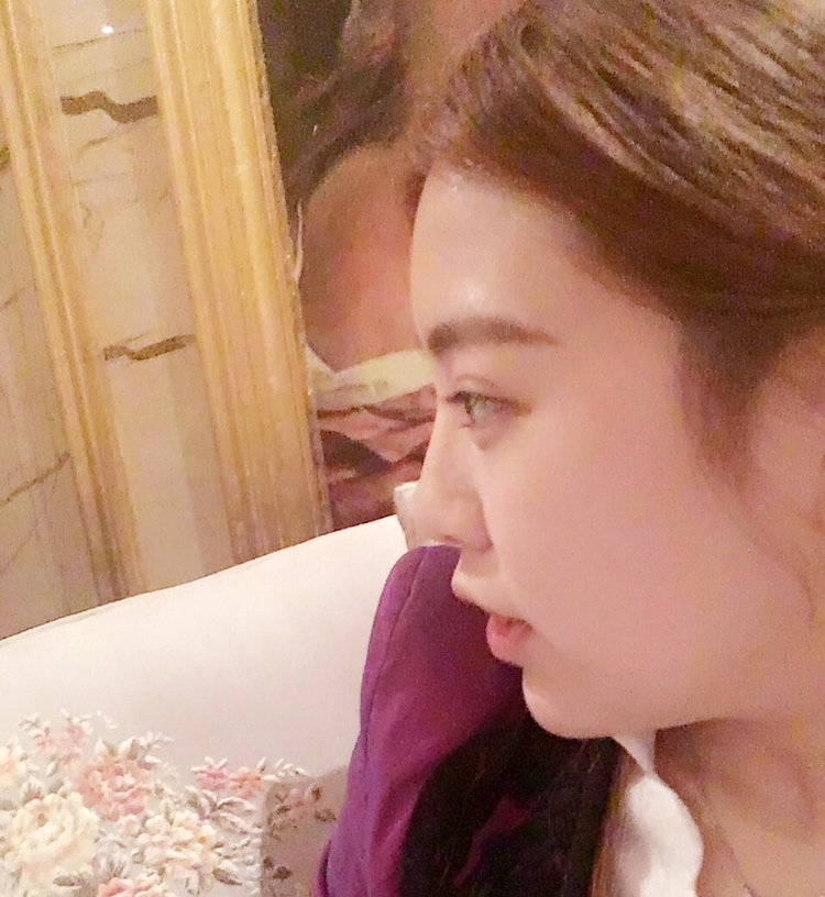 黑龙江艺星医生巫文云做鼻部修复怎么样，巫文云玻鼻部修复案例分享