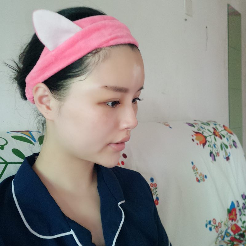 自体脂肪填充脸部案例效果图