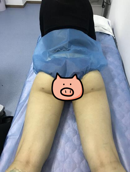 刘永生做大腿吸脂案例