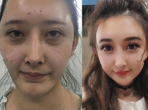 面部脂肪填充，整个人都发生了很大变化。