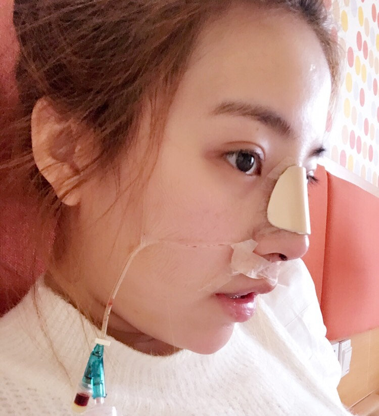 刚做完鼻部修复