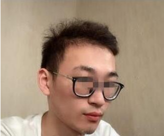 脸上的黑色素沉积使整个人失去光泽