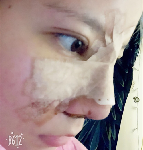 嘉兴曙光美容医院整形专家王良发做假体隆鼻怎么样？王良发假体隆鼻案例