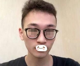 做完彩光嫩肤后的效果