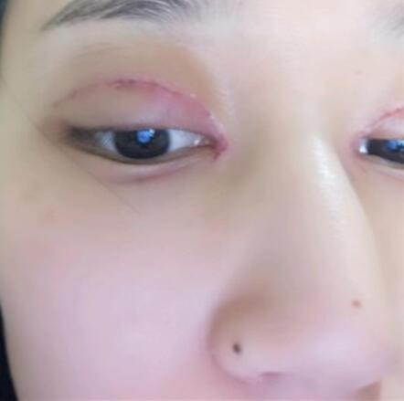 北京叶子整形美容医院做焊接双眼皮效果怎么样？北京叶子整形焊接双眼皮案例展示