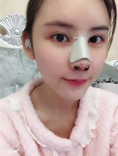 做完肋软骨隆鼻恢复中