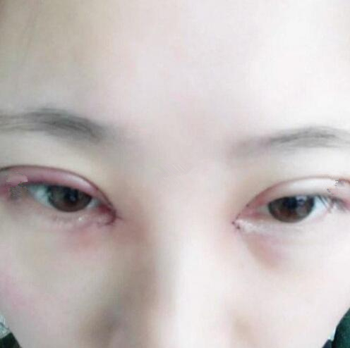 眼综合整形手术后