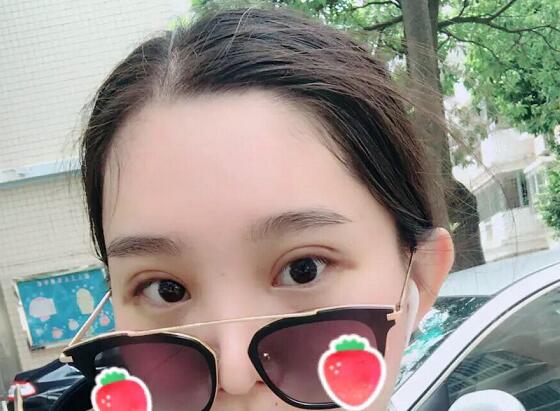 郑州蕾娜斯彭冲医生做微创双眼皮案例效果对比图