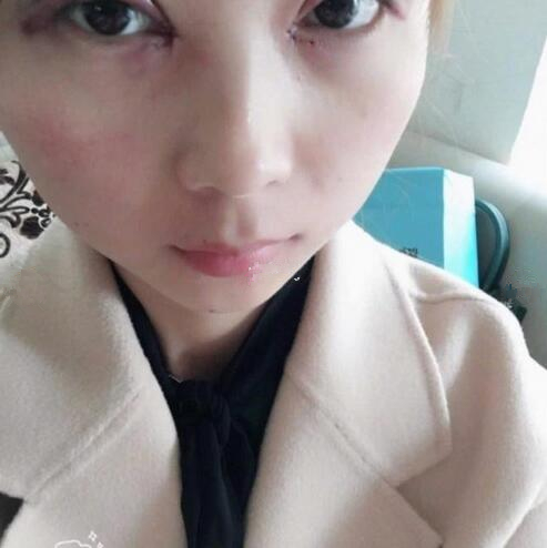 福州久植因美整形医生张晓棠眼综合整形案例分享