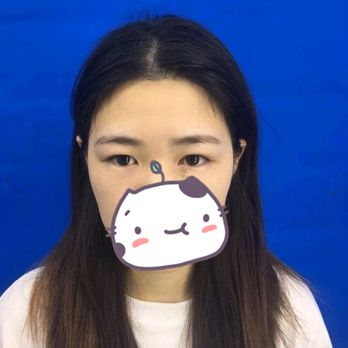 西昌玥美整形专家汤颖峰做双眼皮怎么样？汤颖峰双眼皮案例赏析