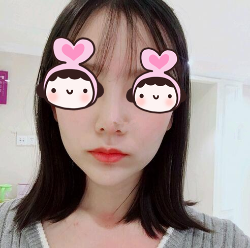 厦门海峡整形专家王翼耕做隆鼻案例分享