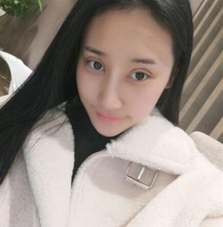 北京叶子整形焊接双眼皮案例展示