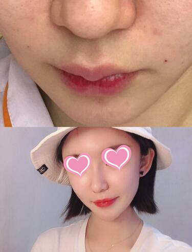 北京当代医院整形专家胡忠明做鼻翼缩小怎么样？胡忠明鼻翼缩小案例分享