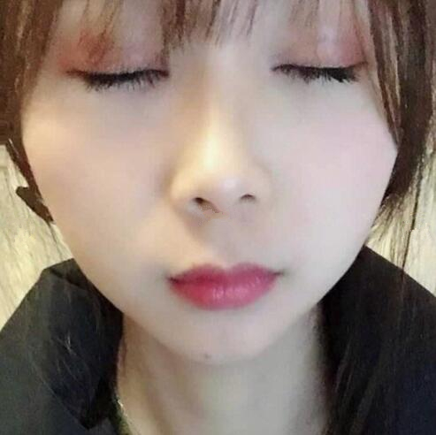 福州久植因美整形医生张晓棠眼综合整形案例分享