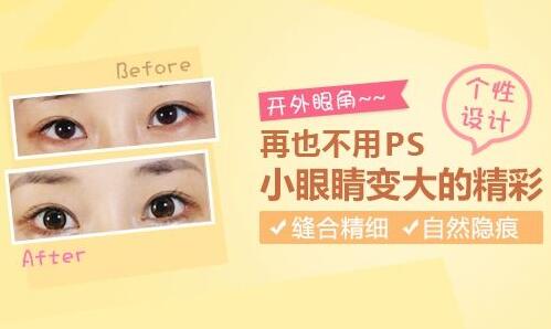 北京美莱整形专家杜园园开外眼角怎么样?