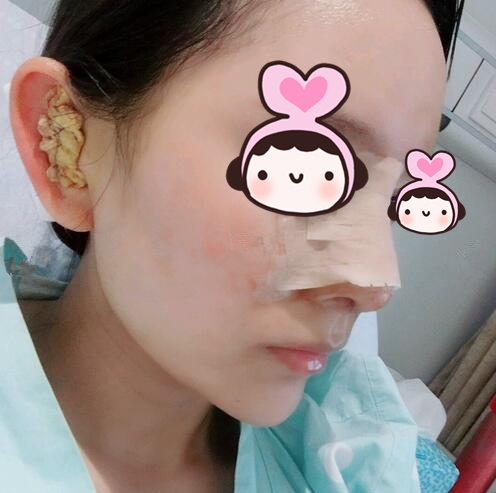 厦门海峡整形专家王翼耕做隆鼻案例分享