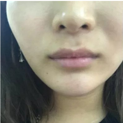 岳阳春天整形专家蒋正华做玻尿酸丰唇怎么样？蒋正华玻尿酸丰唇案例分享