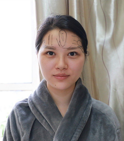 自体脂肪填充脸部案例效果图