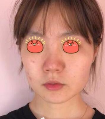成都纽莱茵整形专家郑在祐做下颌角整形怎么样？郑在祐下颌角案例效果展示