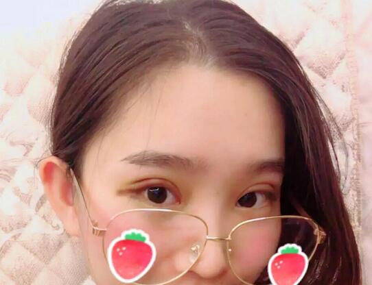 郑州蕾娜斯彭冲医生做微创双眼皮案例效果对比图