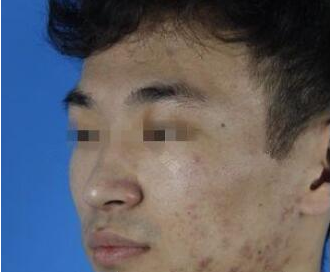 谢娟医生做彩光嫩肤案例