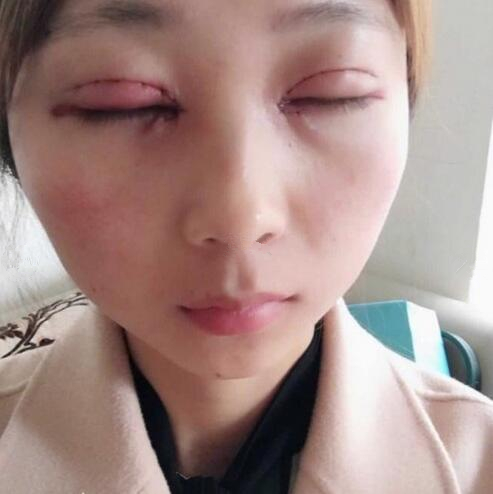 淄博美联臣医疗美容医院做切开双眼皮怎么样？切开双眼皮案例分享