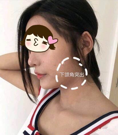 磨骨手术之前