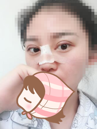 术后60天效果。