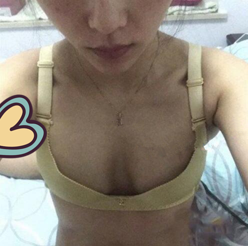 广州驻颜光医疗美容诊所整形专家刘培做复合隆胸技术怎么样？附案例