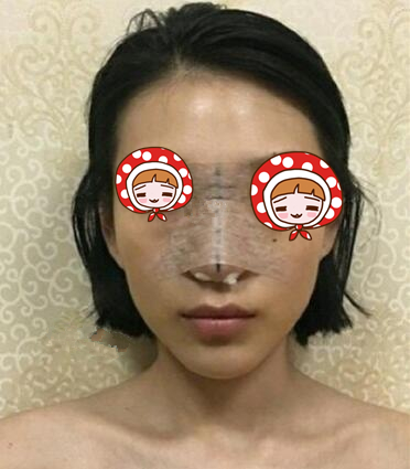 北京京韩医疗硅胶隆鼻案例