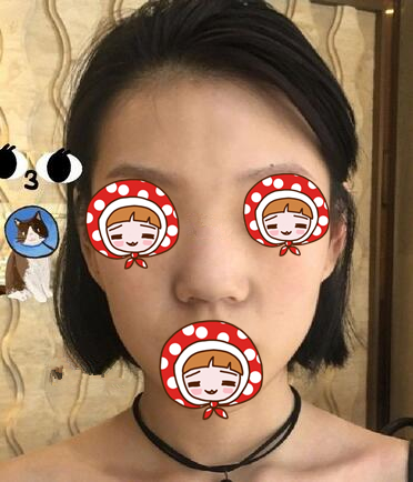 北京京韩医疗硅胶隆鼻案例
