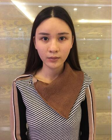 北京艺星整形专家郭峰做假体隆鼻修复怎么样？郭峰假体隆鼻修复案例