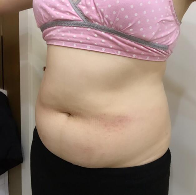 广州星团医学整形医生顾鹏做腹部吸脂效果怎么样?顾鹏腹部吸脂案例展示