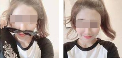 昆明丽都整形医生孟春丽做面部自体脂肪填充效果怎么样？
