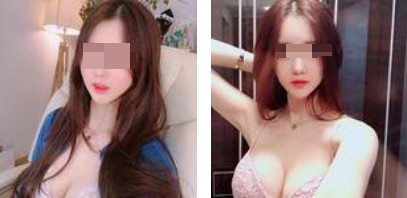 沈阳杏林整形美容医院崔昌墉医生做假体隆胸技术怎么样？附案例