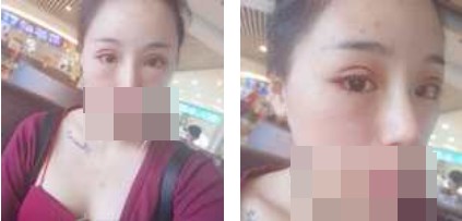 宁波美仁整形美容医院李英大医生做切开双眼皮效果怎么样？