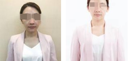 上海攸维医疗美容诊所整形医生李静做膨体隆鼻案例展示