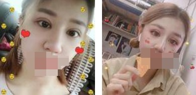 做了全切双眼皮不仅外表变美了，内心也更加自信了