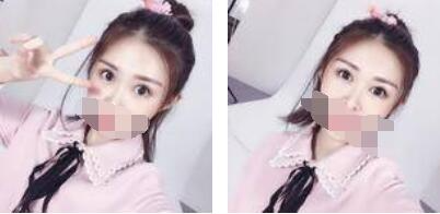 没有了眼袋困扰，身体和心态都年轻了十岁