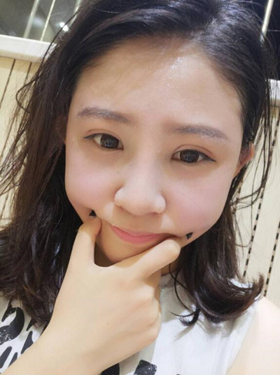 海南添美整形外科医生王晓军做自体软骨隆鼻+双眼皮+祛眼袋案例效果对比图