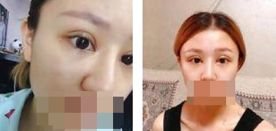 全切双眼皮恢复过程