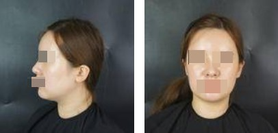 面部吸脂让你做一个更受欢迎的精致“小脸”的女人