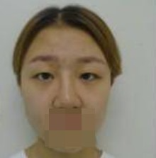 做了全切双眼皮不仅外表变美了，内心也更加自信了