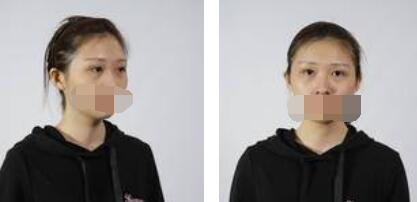 没有了眼袋困扰，身体和心态都年轻了十岁