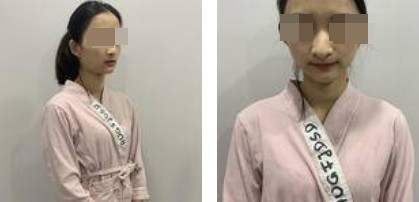 美丽自信的生活从自体软骨隆鼻开始